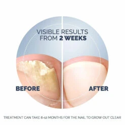 Scholl Kalknagel Behandelset -Metagenics Winkel 1053908 6